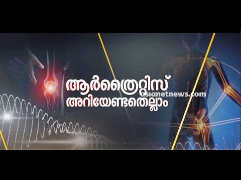 ആര്‍ത്രൈറ്റിസ് രോഗത്തെക്കുറിച്ച് അറിയേണ്ടതെല്ലാം