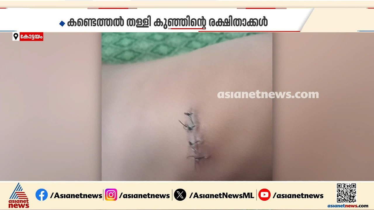 'ചികിത്സ പിഴവില്ല'; കുഞ്ഞിന്റെ ശരീരത്തിൽ സൂചി കണ്ടെത്തിയ സംഭവത്തിൽ അന്വേഷണ റിപ്പോർട്ട് പുറത്ത്