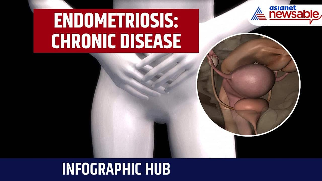 Infographic Hub | Endometriosis: Chronic Disease Affecting 1 in 10 Women Globally