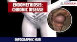 Infographic Hub | Endometriosis: Chronic Disease Affecting 1 in 10 Women Globally