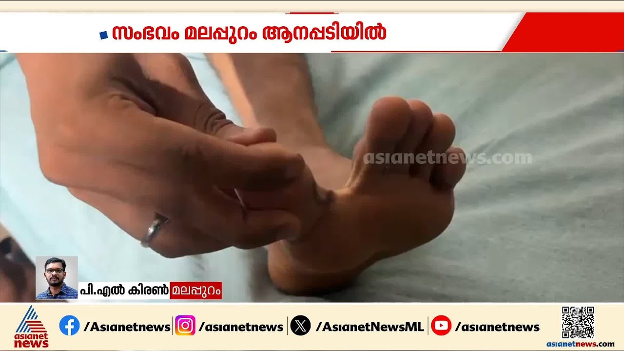 കടിച്ച പാമ്പിനെയും കൊണ്ട് ആശുപത്രിയിലെത്തി യുവാവ്, അമ്പരന്ന്  ഡോക്ടർമാർ