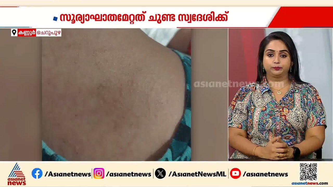 കണ്ണൂരിൽ വീണ്ടും സൂര്യാഘാതം; തൊഴിലുറപ്പ് ഓവർസിയർക്ക് കഴുത്തിലും കൈയിലും പൊള്ളൽ | Sun Burn