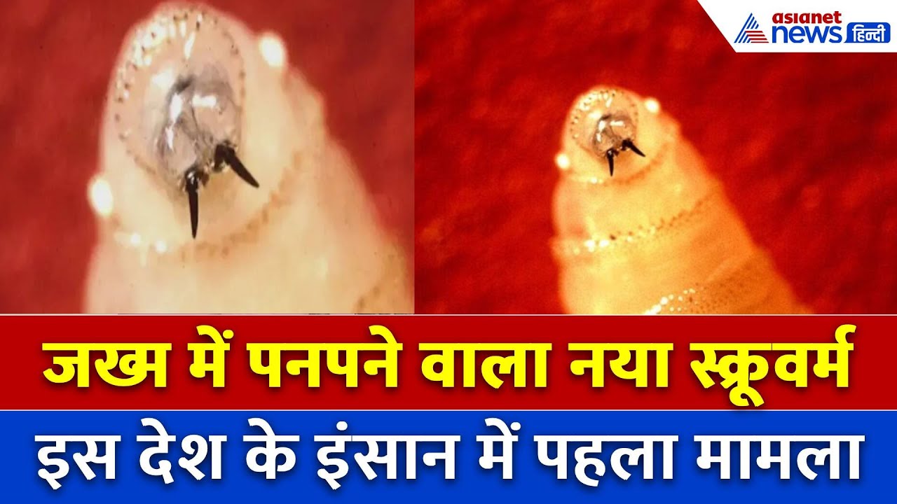 Corona से ज्यादा खतरनाक New World Screwworm इस देश के इंसान में मिला पहला मामला, अलर्ट मोड में दुनिय