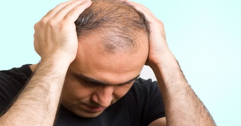 baldness 56499.jpg