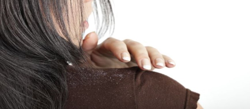 home remedies for Treat dandruff